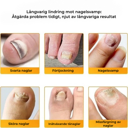 FungalPatch - Antibakteriell Svampdödande Plåster och Nagelvårdspaket