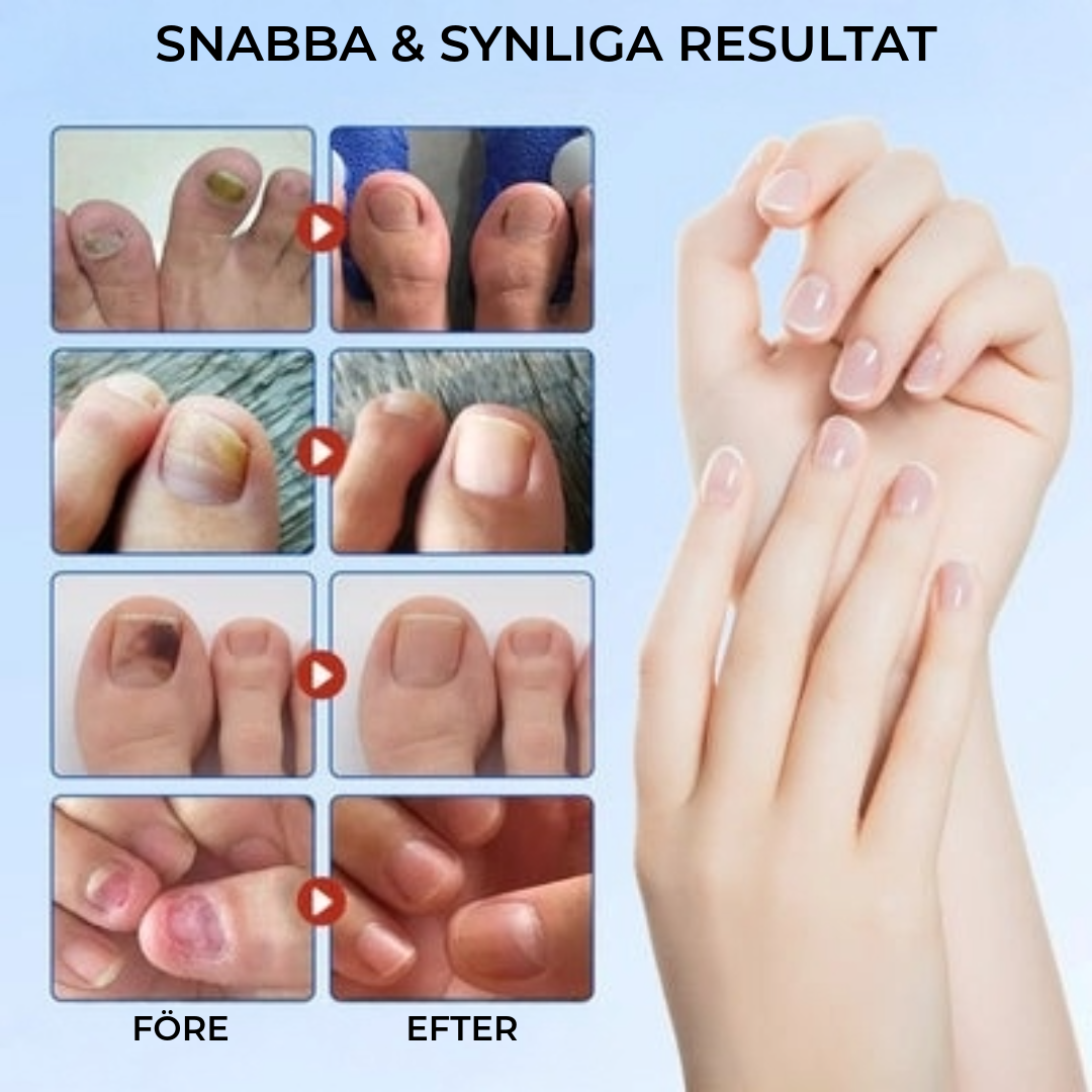 FungalPatch - Antibakteriell Svampdödande Plåster och Nagelvårdspaket