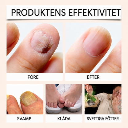 Bigiftsspray mot nagelsvamp